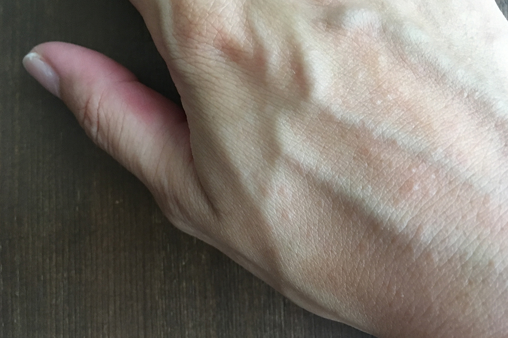 手の甲の発疹